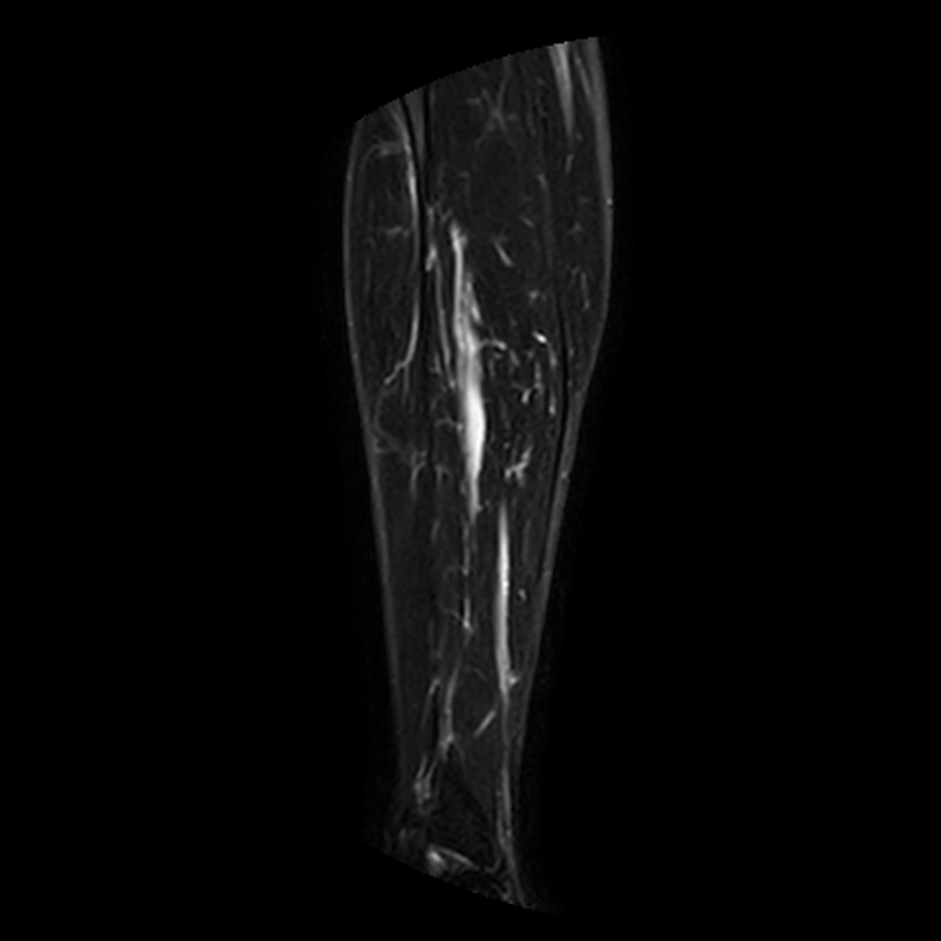 coronal stir clean